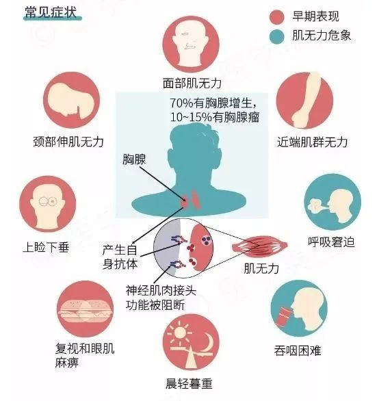 重症肌无力症状有哪些