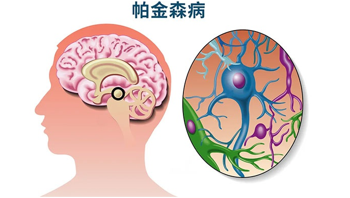 帕金森综合征如何治疗?