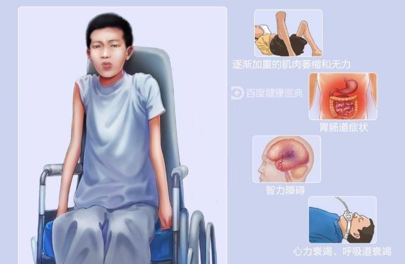 进行性肌营养不良要怎样治疗？