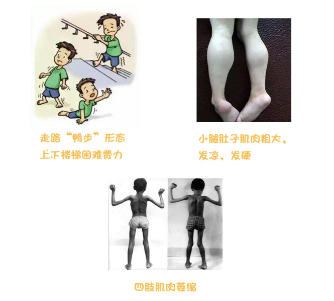 假肥大型肌营养不良的药物治疗方法