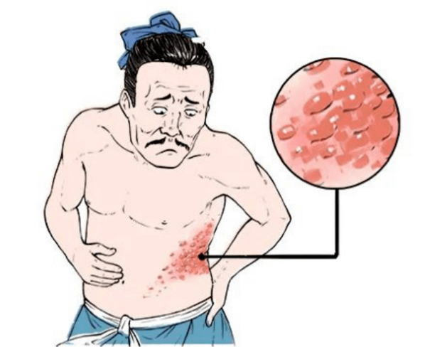 带状疱疹后神经痛患者的日常注意事项