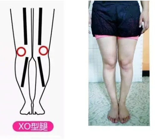 X型腿的矫正治疗方法