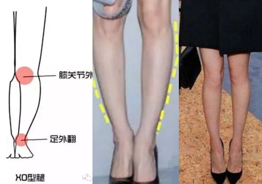 病理性O型腿的治疗方法