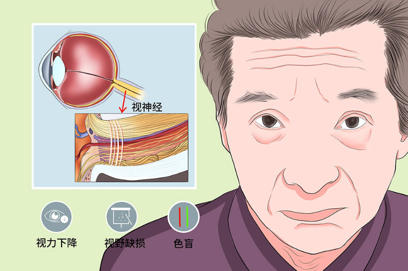 视神经萎缩的临床治疗方法