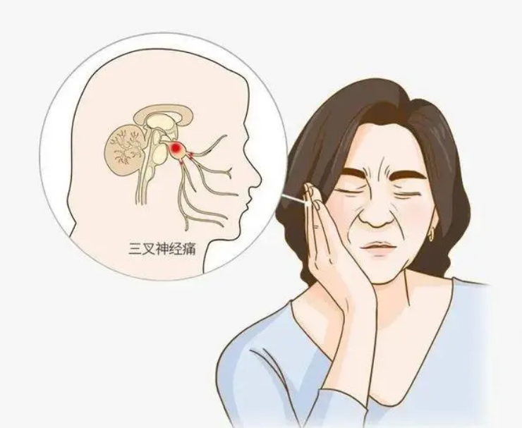 下颌支三叉神经痛怎样治疗?