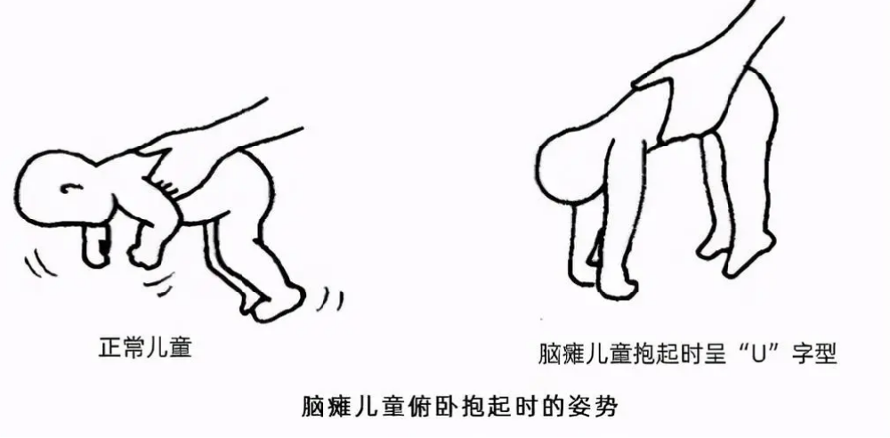 痉挛型脑瘫剪刀脚怎么治疗？
