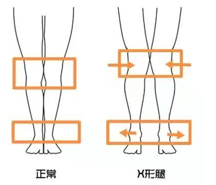 X型腿的形成原因和护理方法