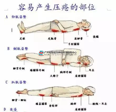 【每日必读】脊髓损伤10大常见并发症预防及康复措施