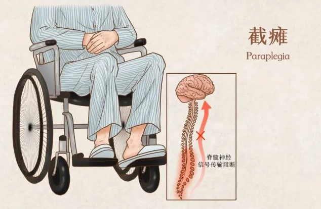脊髓损伤治疗方法都有哪些?