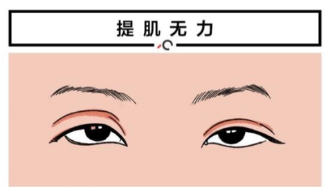 眼肌型重症肌无力的治疗方法