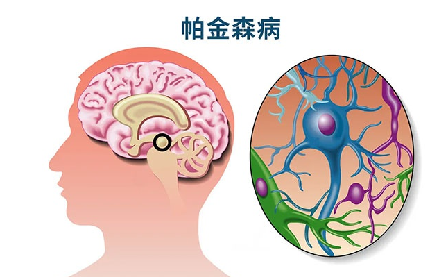 帕金森综合征如何治疗?