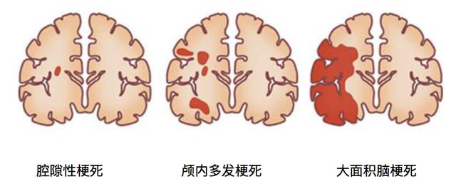 脑梗后遗症多久能恢复?剖析影响脑梗后遗症恢复时间的关键因素