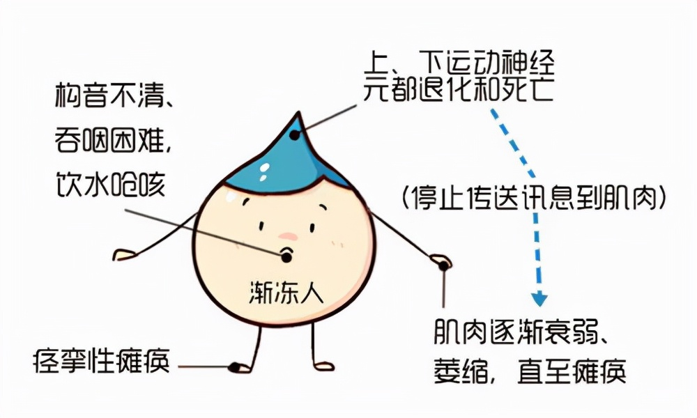 运动神经元病患者肌肉萎缩无力怎么办？