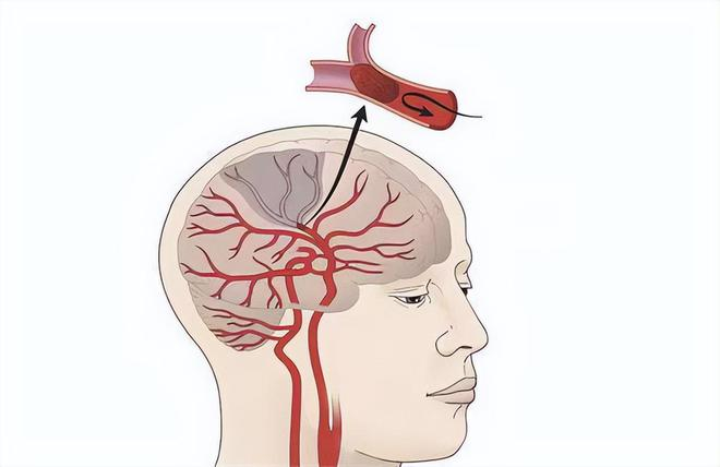 医学科普丨从脑梗塞到脑萎缩:脑血管疾病的连续谱