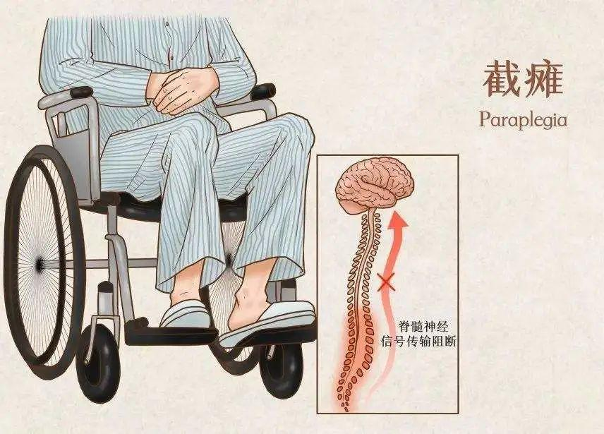 截瘫患者如何有效预防尿路感染?