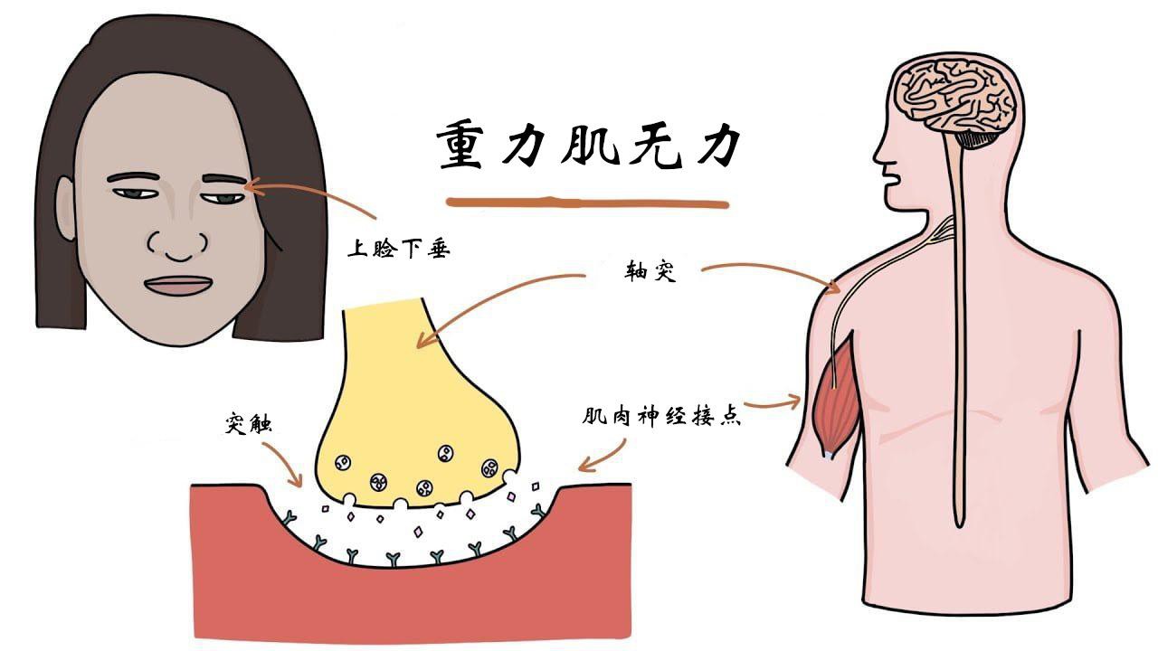 重症肌无力3大危象：这些症状可能危及生命，早了解早防范
