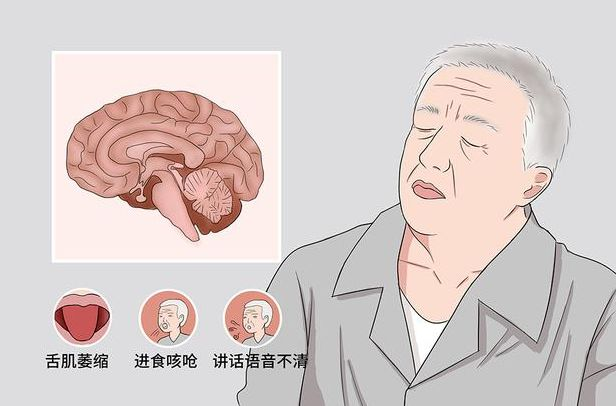 运动神经元病患者出现排便困难怎么办？这些运动方式和习惯可帮助缓解
