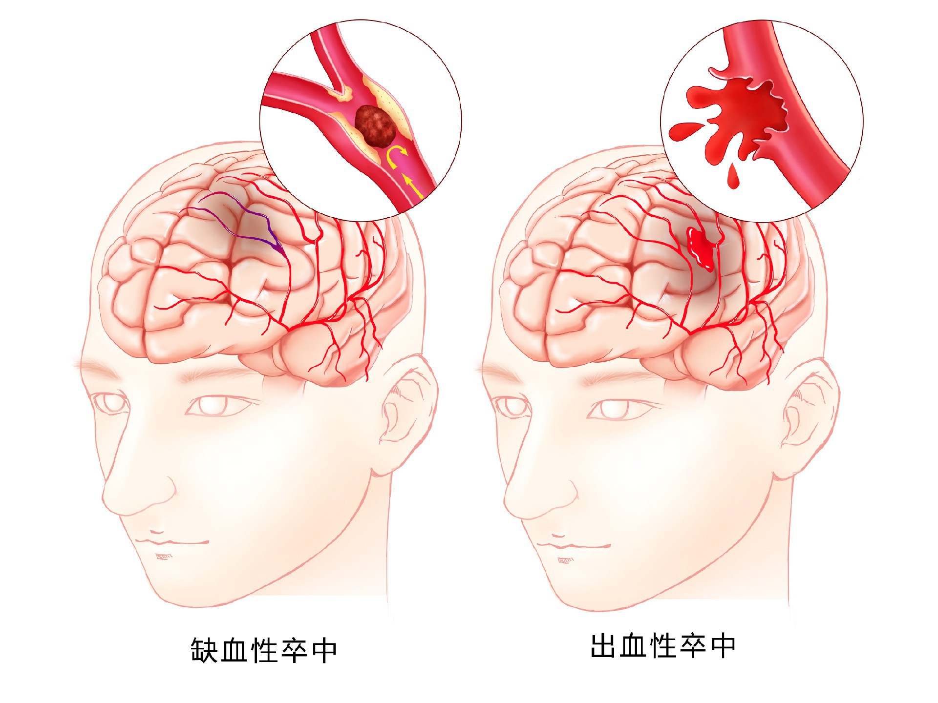 脑出血后遗症患者如何提高生活能力