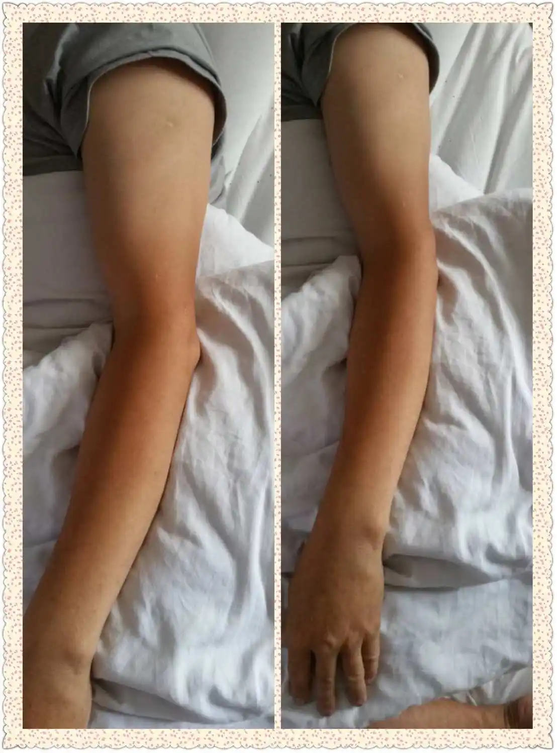 肌肉萎缩和肌无力的区别和联系，如何预防肌肉萎缩？