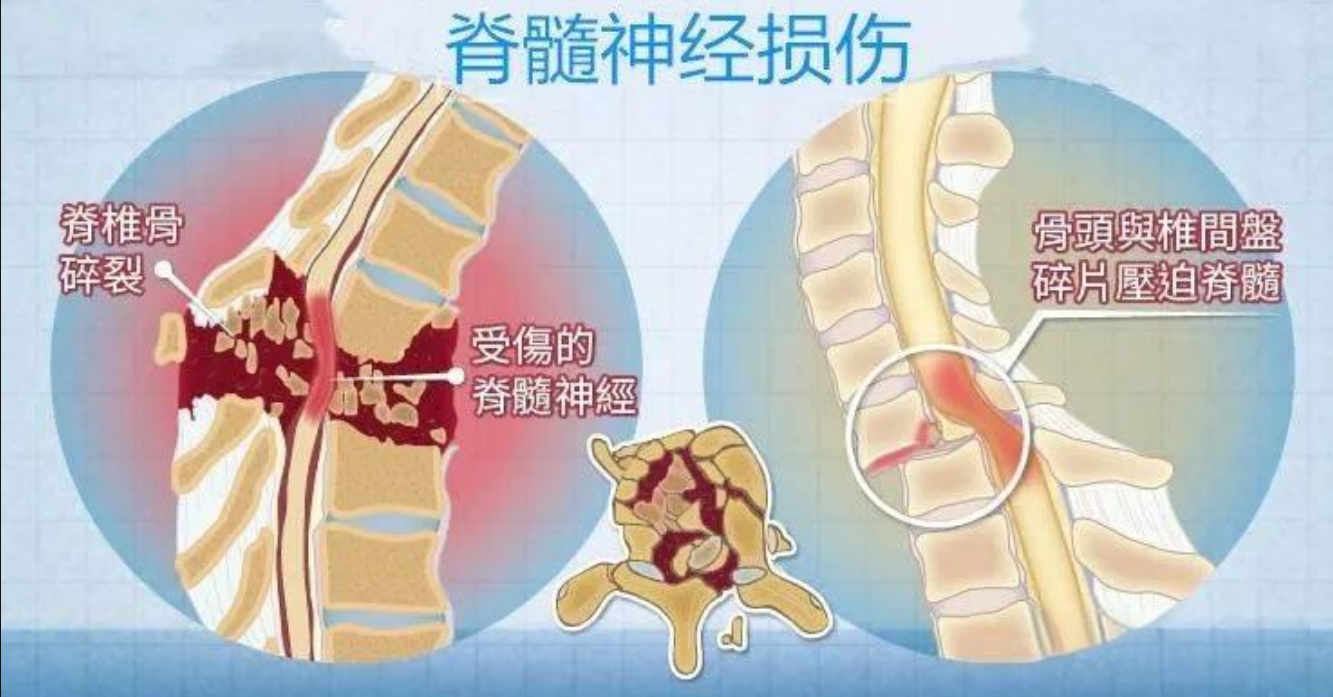 哪些迹象表明受损神经在恢复中？