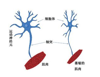 同一屋檐下的不同面孔：运动神经元病VS肌萎缩侧索硬化症