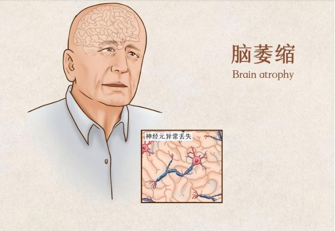 从蹒跚到跌倒：小脑萎缩对身体协调的渐进影响