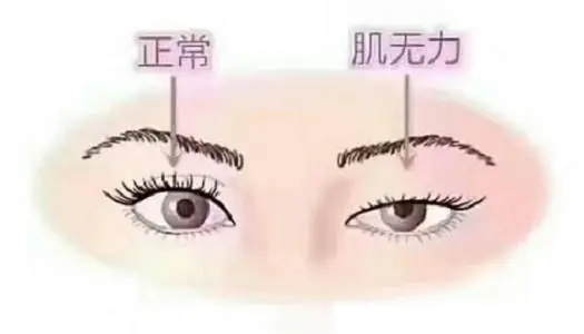 【科普小课堂】重症肌无力眼肌型会发展为全身型吗？
