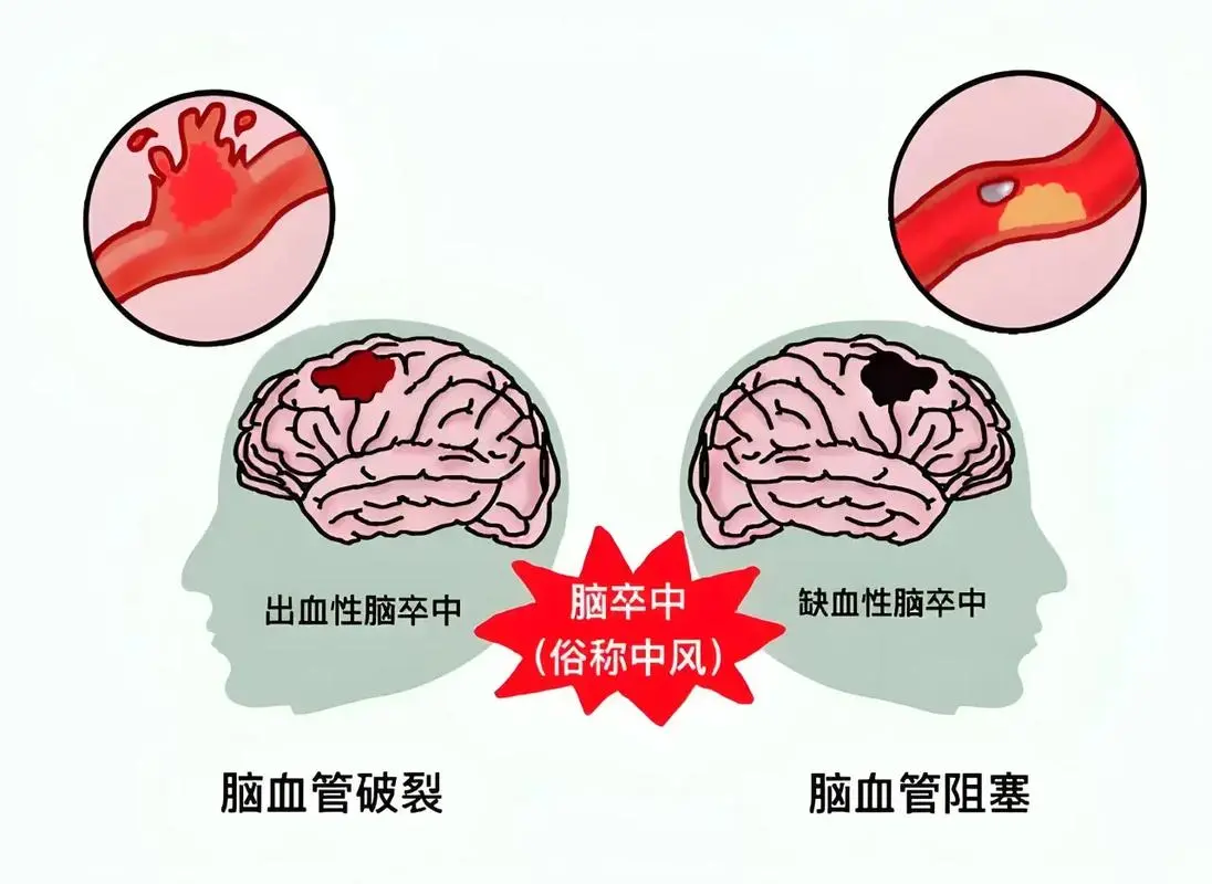 脑卒中后的挑战：患者为何日渐消瘦？