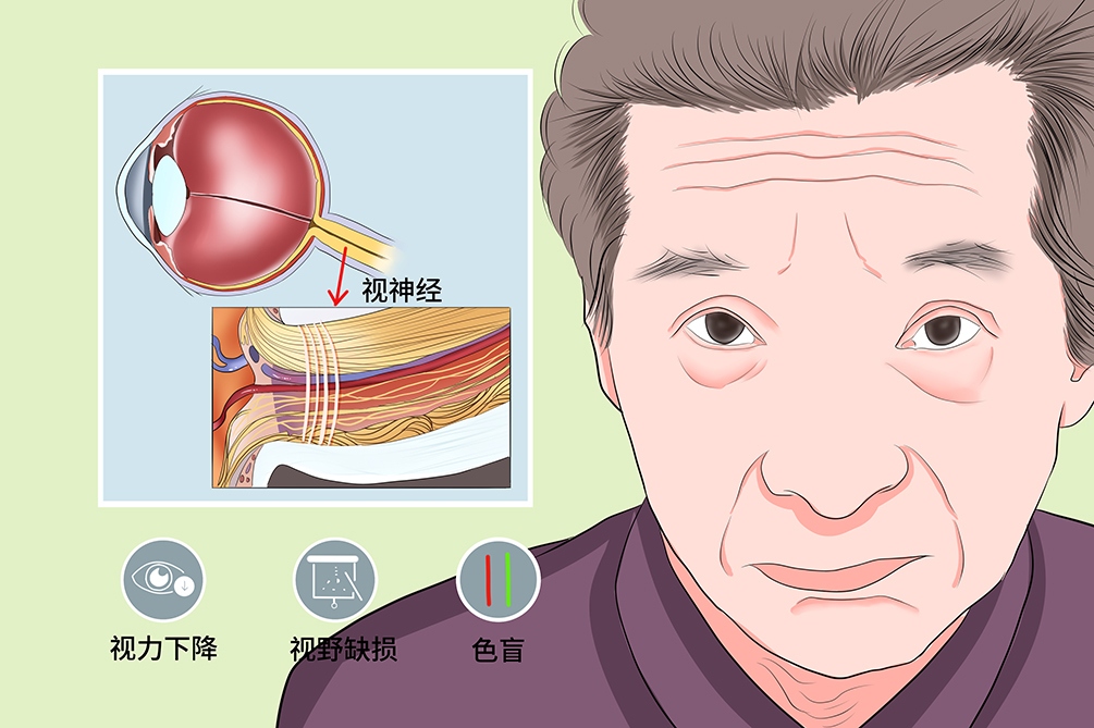 视神经萎缩患者多久会失明:从轻度衰退到完全失明的轨迹