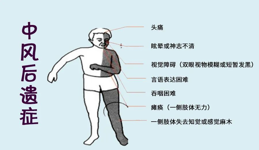 康复指导:中风偏瘫患者如何避免肩手综合征的发生