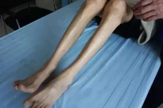 肌肉萎缩患者注意：医生提醒科学锻炼恢复肌肉力量要这样做