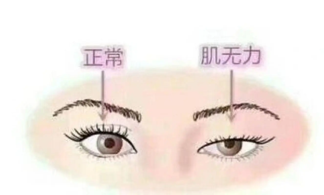 眼肌型重症肌无力的危害有多大？