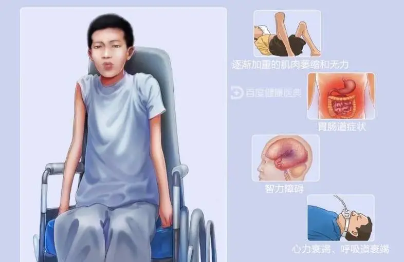 儿童肌营养不良：家长必知的营养与健康知识