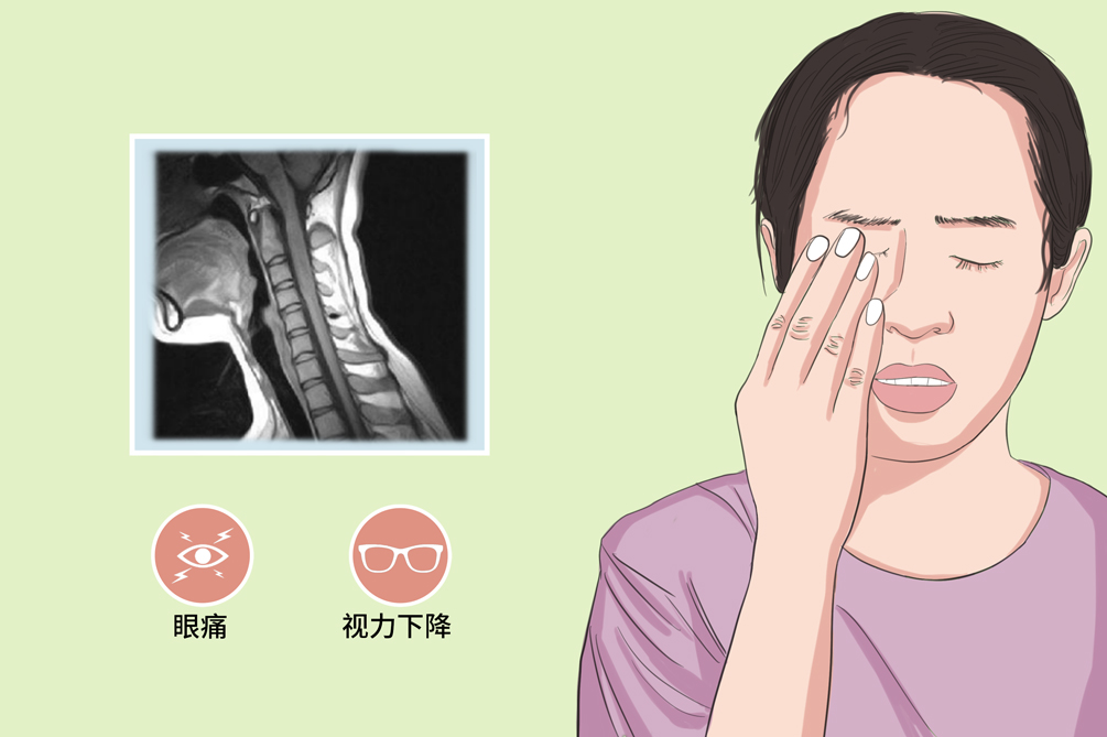 视神经损伤患者的日常护理要点