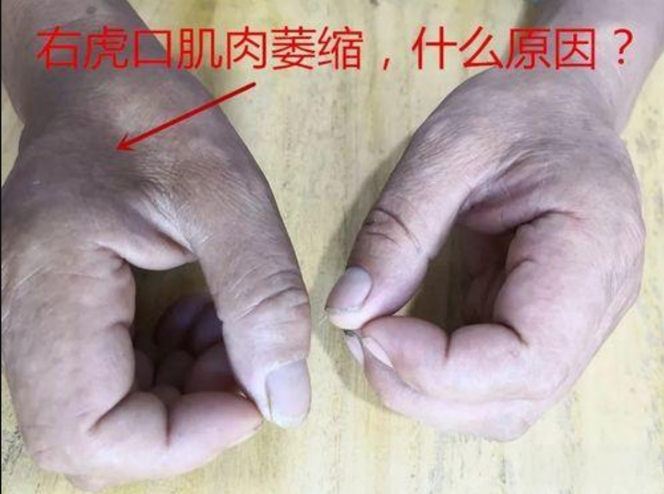 虎口肌肉萎缩：运动神经元损伤的早期预警？
