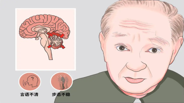 小脑共济失调的的遗传概率有多高?一篇文章让你了解清楚