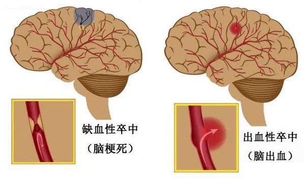 脑梗后遗症与脑出血后遗症哪个更严重?