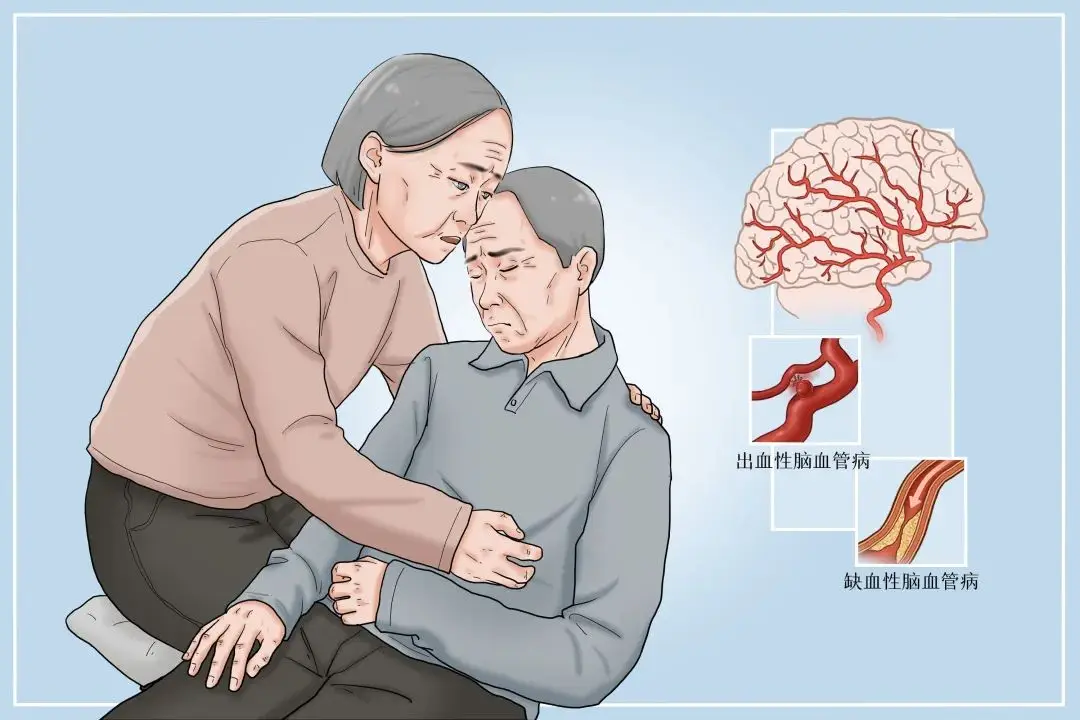 脑卒中偏瘫患者如何防止患肢肌肉萎缩