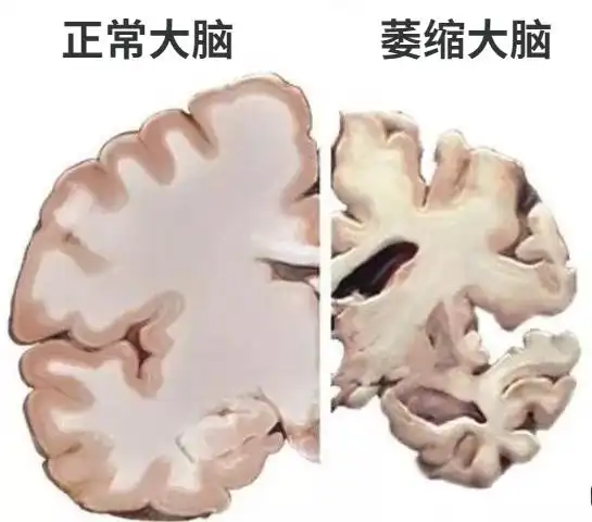 从自然老化到病理性脑萎缩:治疗时机的把握