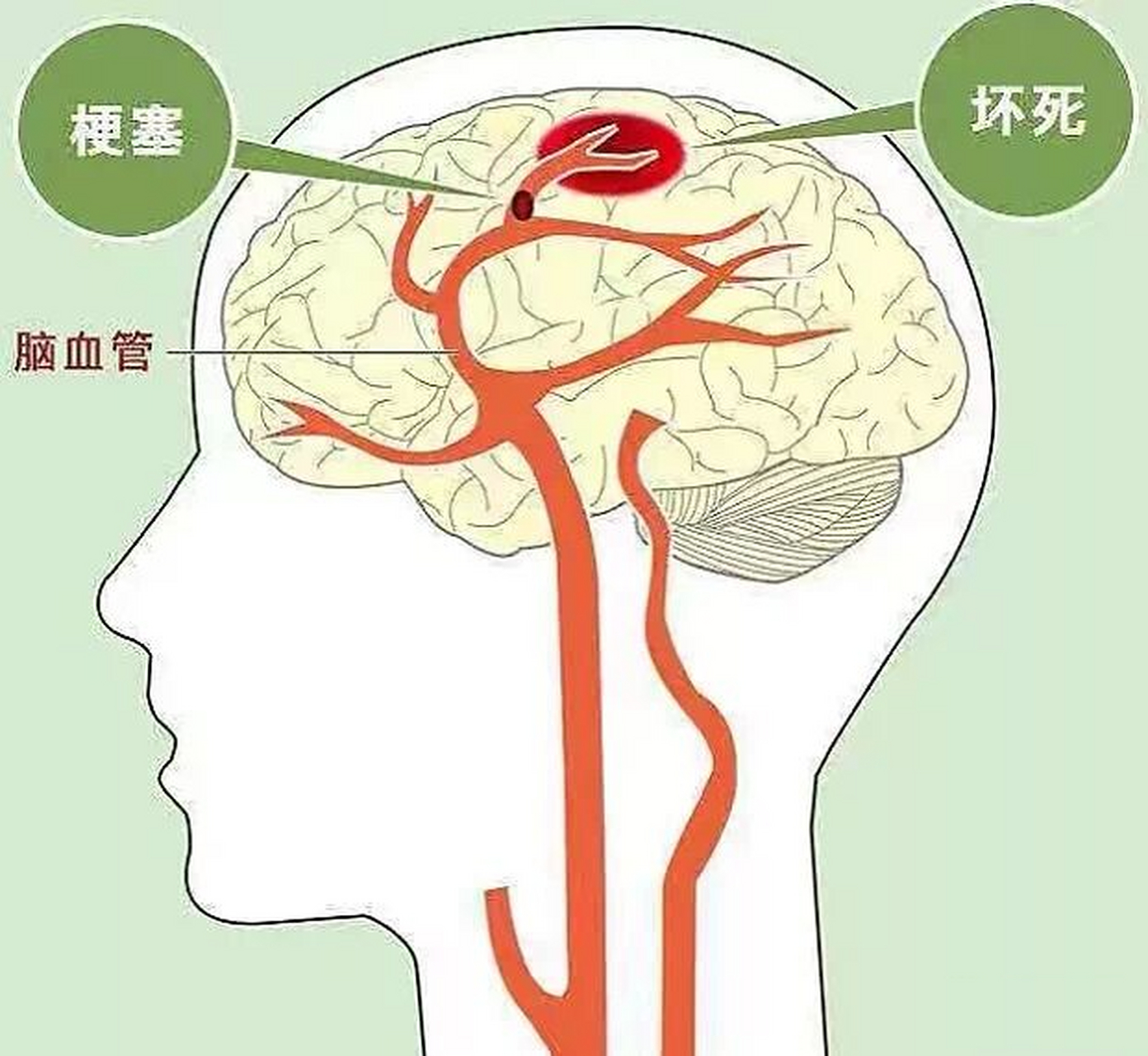 轻微脑梗后是否需要长期服药?