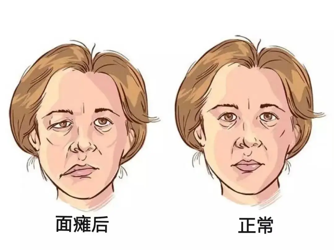 面瘫后,怎么知道神经在恢复?3个表现预示着你的神经开始恢复