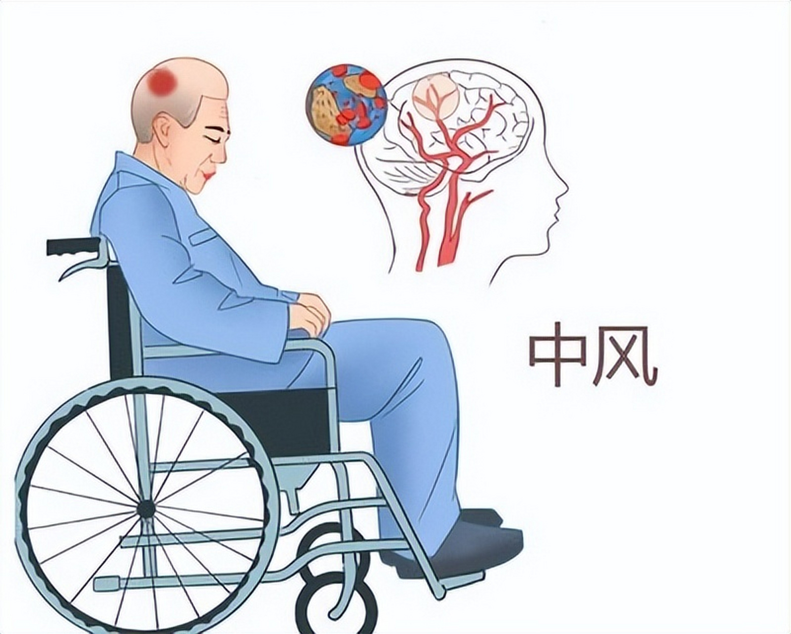 脑中风后遗症：偏瘫侧肢体无力，如何应对？