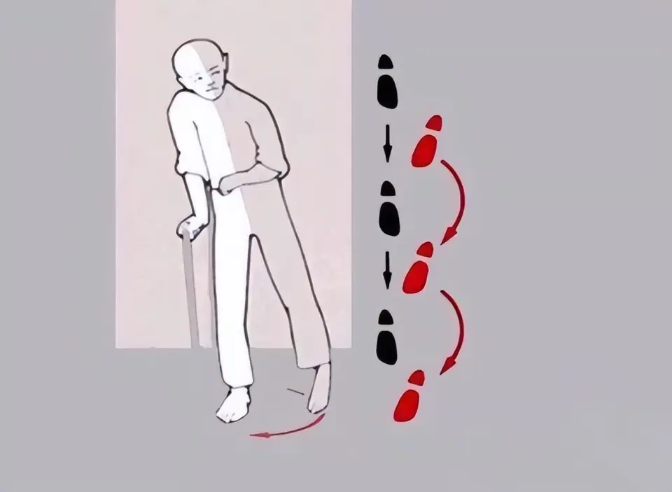 中风偏瘫软瘫期康复：如何实现个性化的精准康复训练？