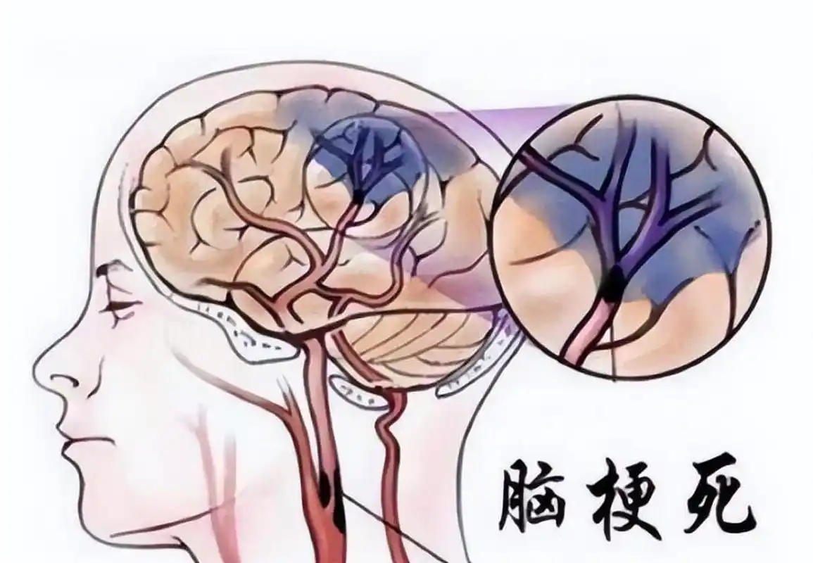 谨防脑梗再次复发,医生提醒:3类食物要少吃