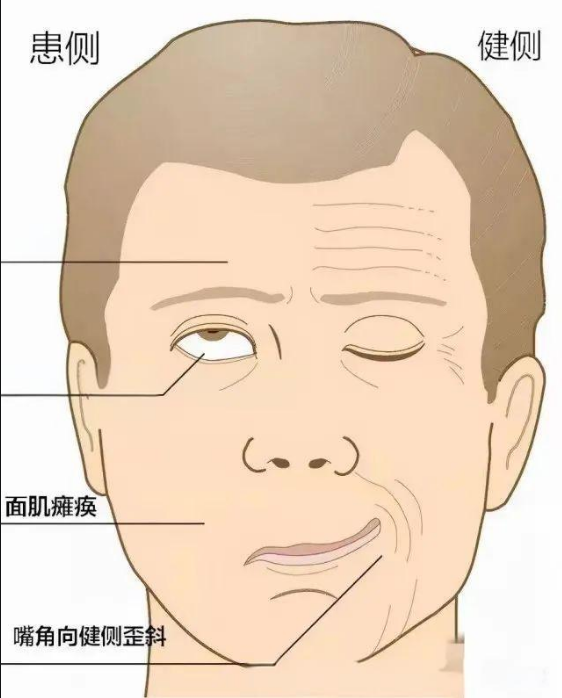 面瘫恢复时间线：面神经损伤后多久能恢复正常？