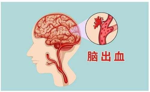 脑出血后腿发沉僵硬怎么办？医生教你如何应对