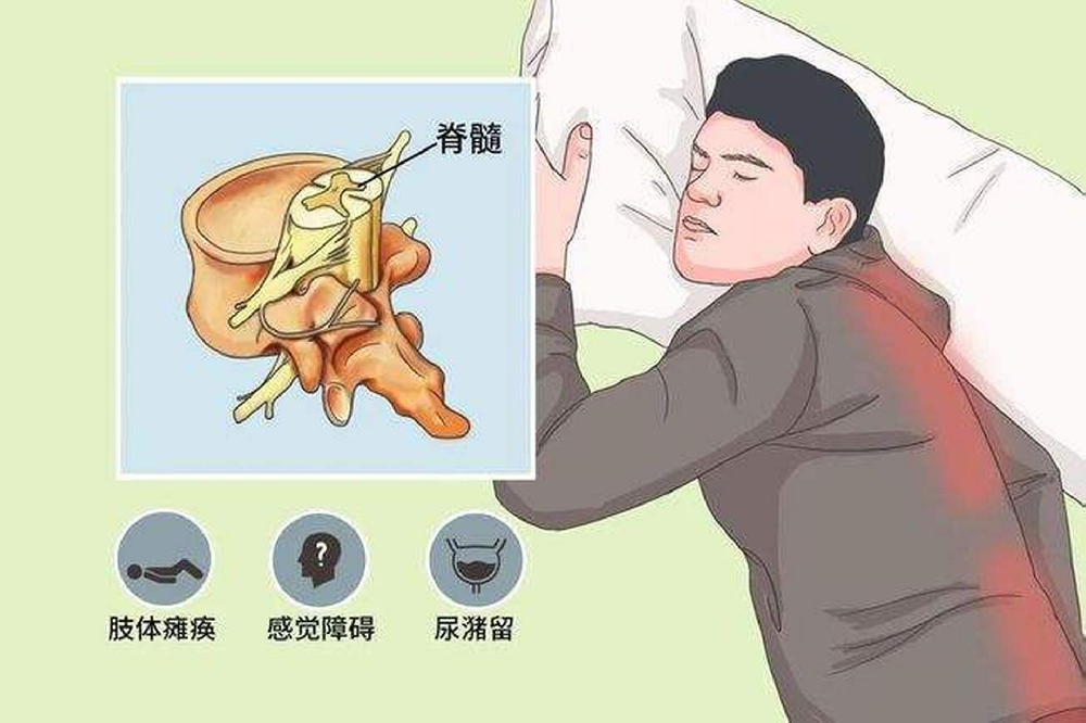 盲目理疗=加速恶化！脊髓炎黄金期必须避免的5大陷阱