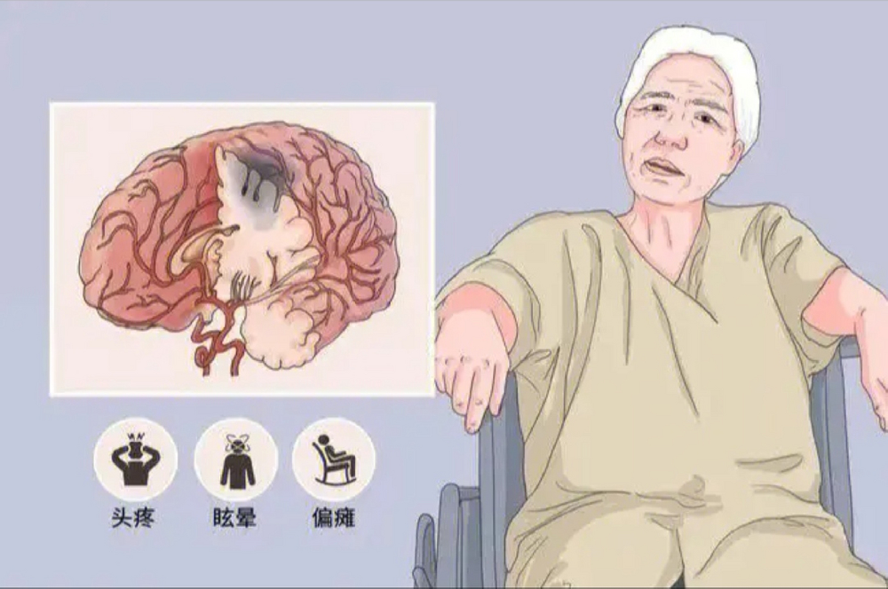 抓住黄金期!脑梗患者康复的“三步走”策略