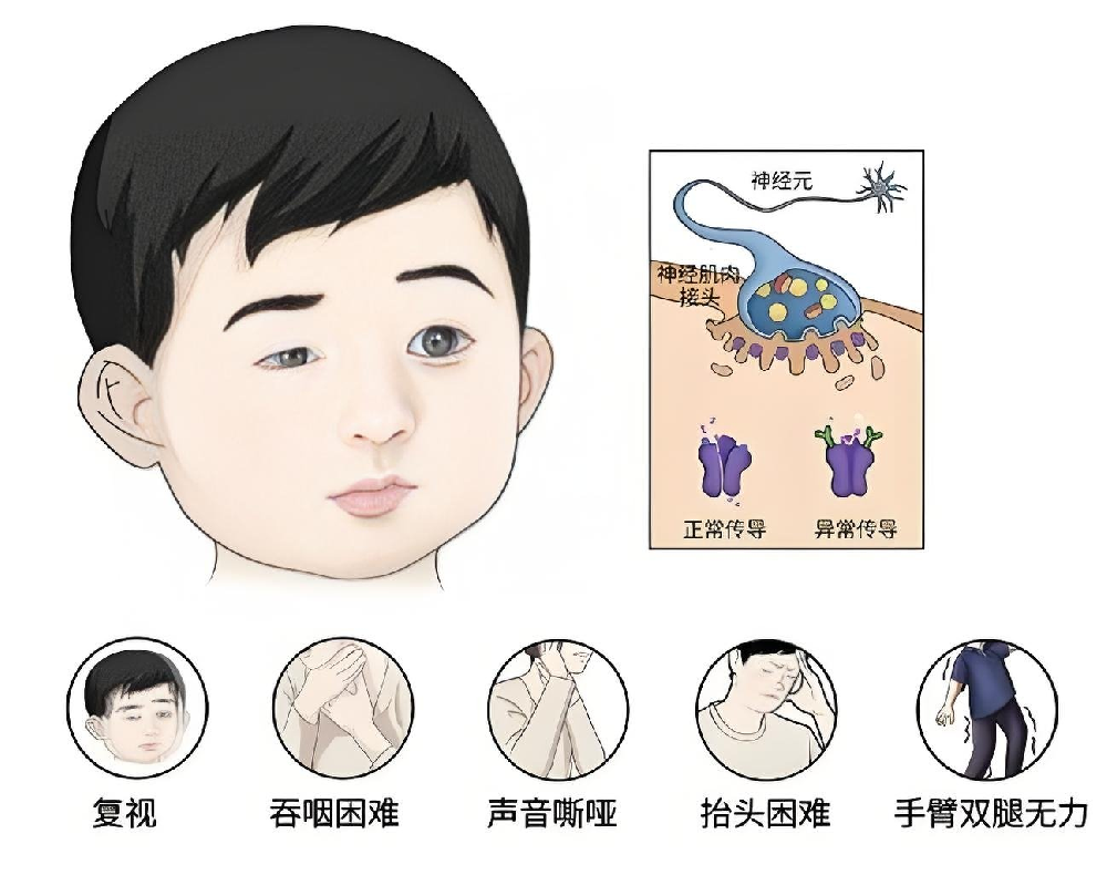 从卧床到自理：重症肌无力患者的康复训练指南