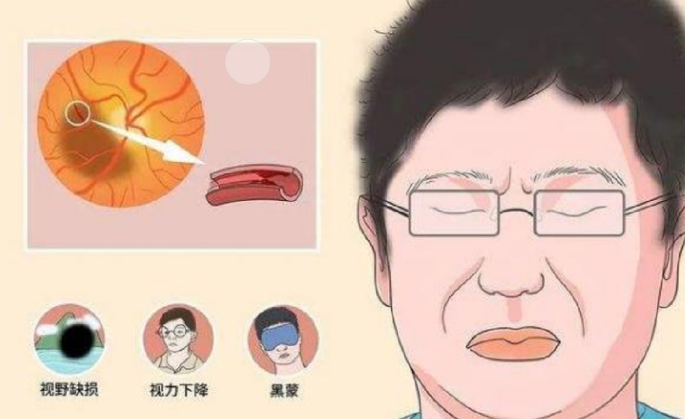 视神经萎缩不治疗，多久会失明？